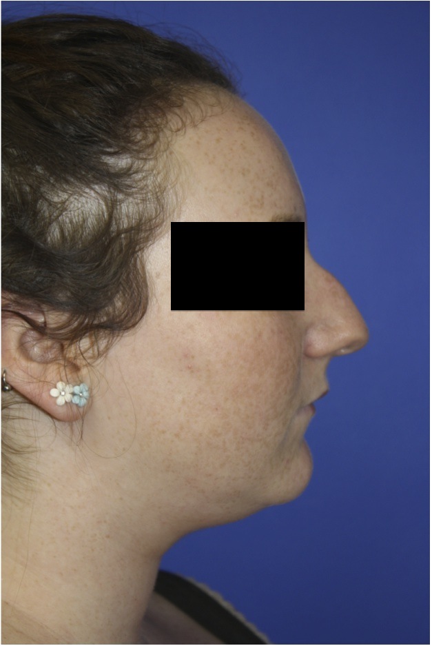 Female Profile Before Rhinoplasty with Nose Bump