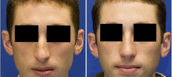 Facial Fracture Before and After Surgery on Male