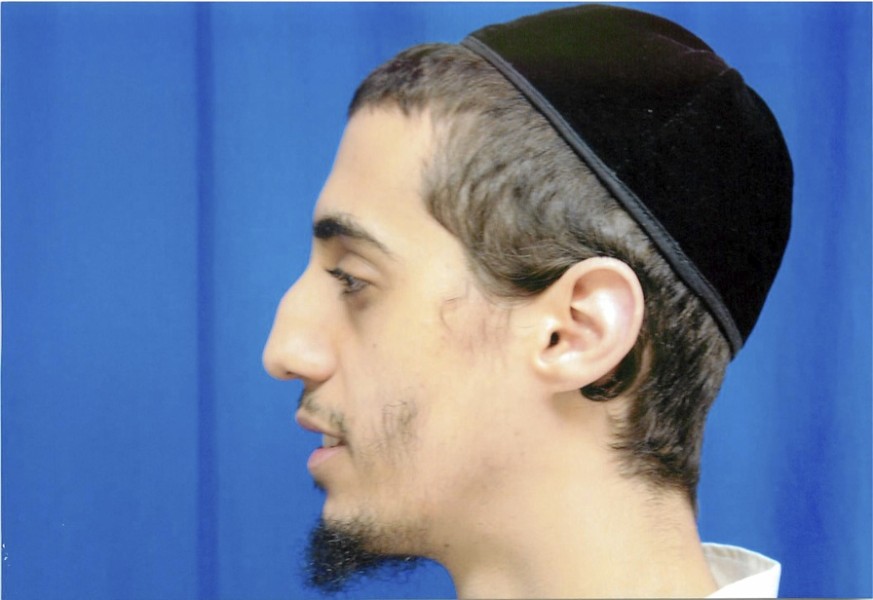 Male Rhinoplasty Patient Before Photo