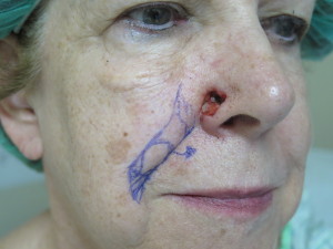 2 Before with Flap Design (Skin Cancer Excision)