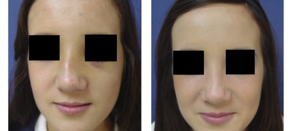 Facial Fracture on Female Before and After Surgery