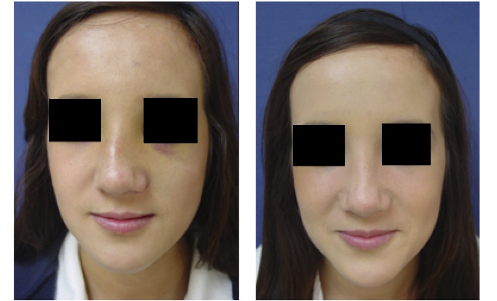 Facial Fracture on Female Before and After Surgery