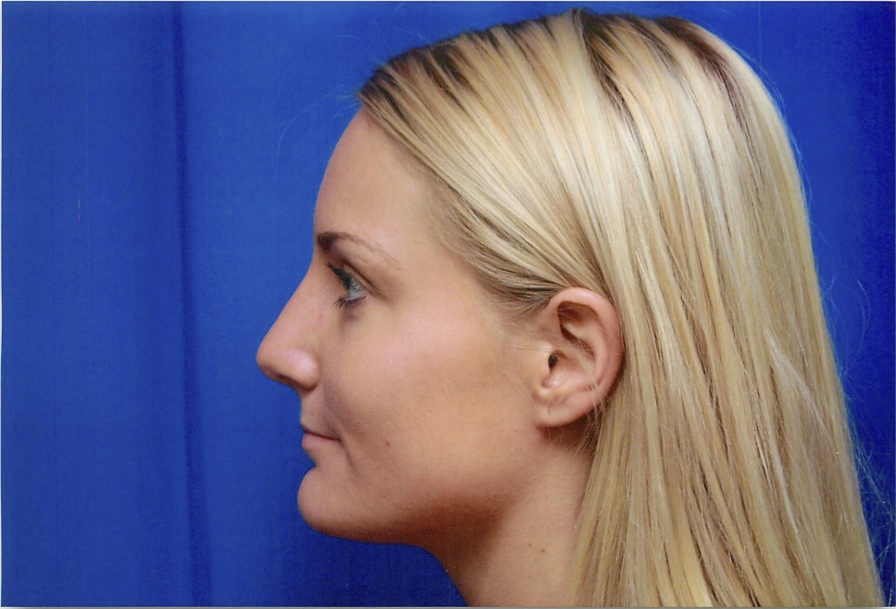 After Rhinoplasty Surgery to Remove Bump in Nose, Left Side
