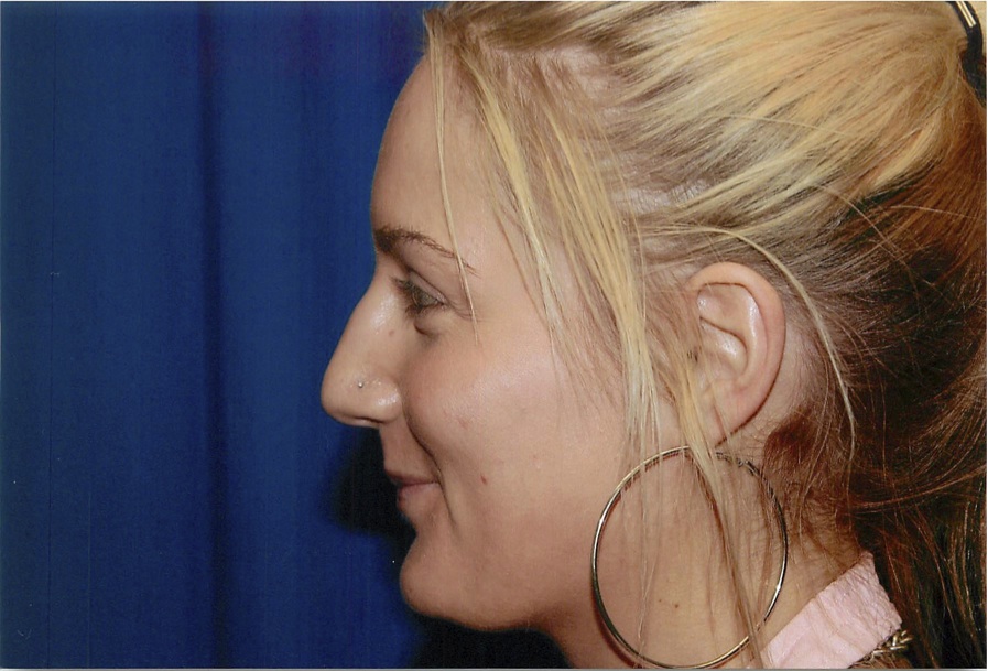 Before Rhinoplasty Surgery to Remove Bump in Nose, Left Side