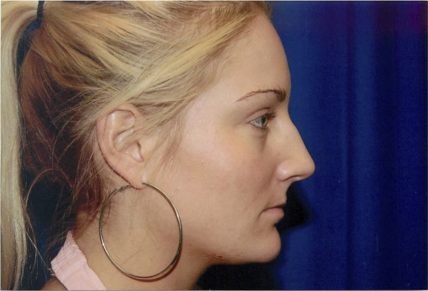 Before Rhinoplasty Surgery to Remove Bump in Nose