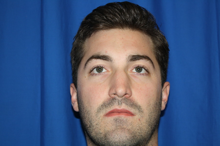 Male Rhinoplasty Patient Front Before Photo, Nose Shape