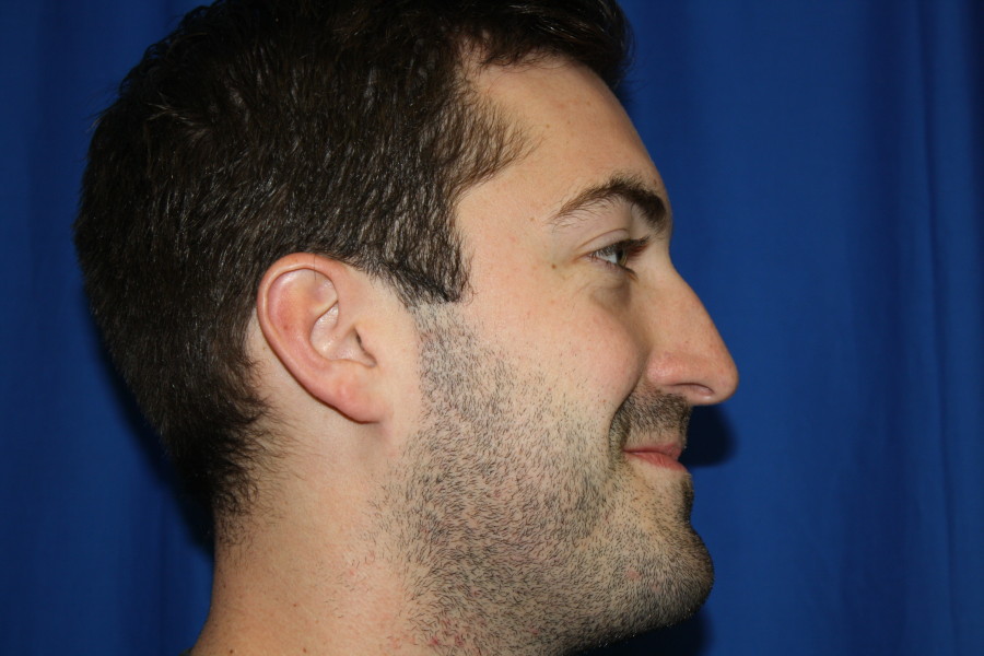 Male Rhinoplasty Before Photo, Right Side