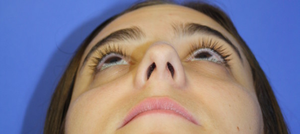 Looking Up View Before Rhinoplasty Surgery