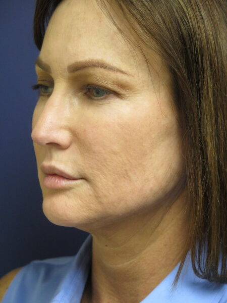 Female Prior to Face and Neck Lift Surgery