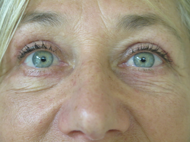 Eyes Close Up After Blepharoplasty