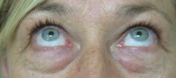 Female Eyes Up View Before Blepharoplasty