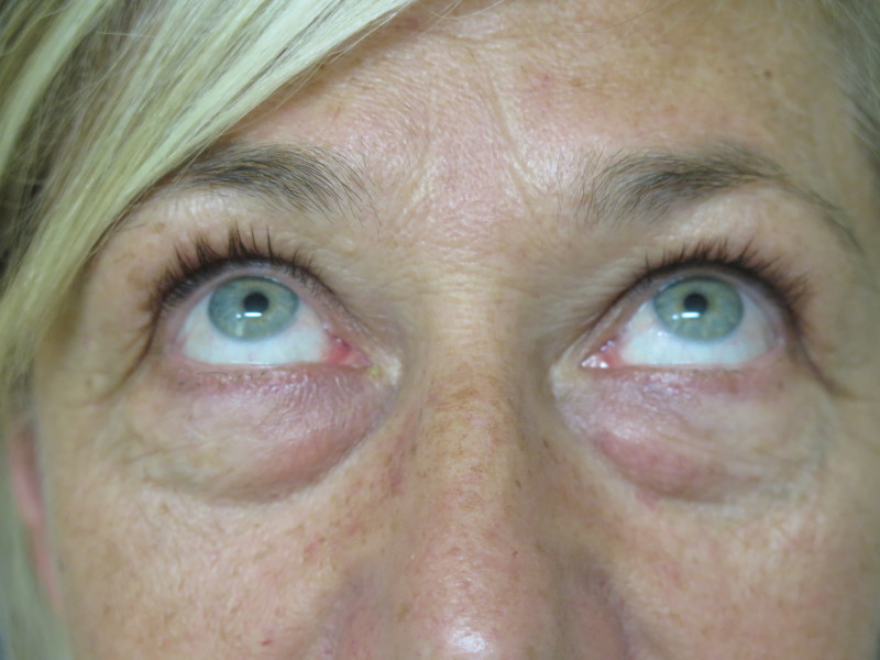 Female Eyes Up View Before Blepharoplasty