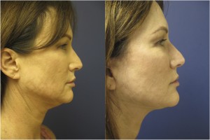 Face and Neck Lift Side Before and After of Female