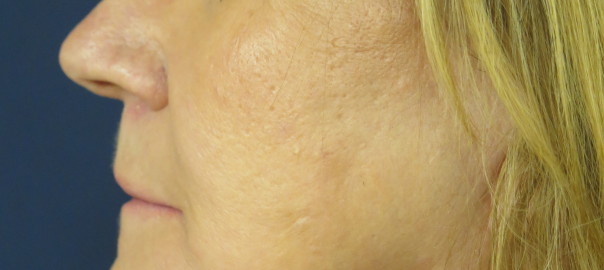 Female After Photo from Face and Neck Lift