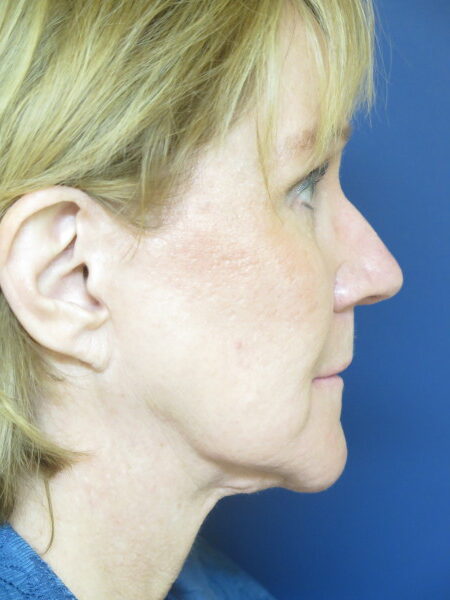 Female Before Photo Face and Neck Lift