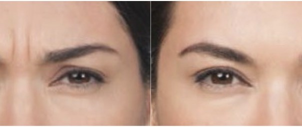Botox Center Brow Before and After