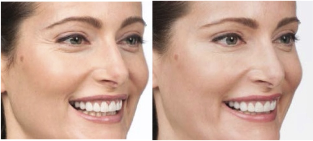 botox crows feet before and after