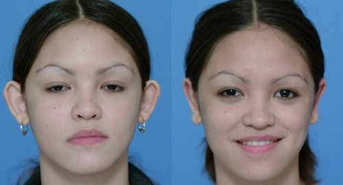 Otoplasty Surgery, Before and After Photo