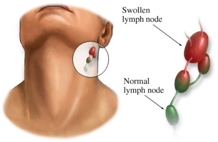 See the Difference between a Swollen and Normal Lymph node