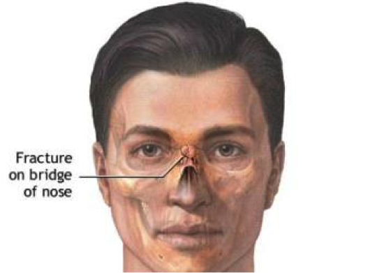 Nasal Fracture Repair