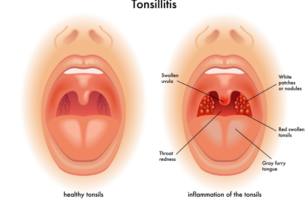 Tonsillitis